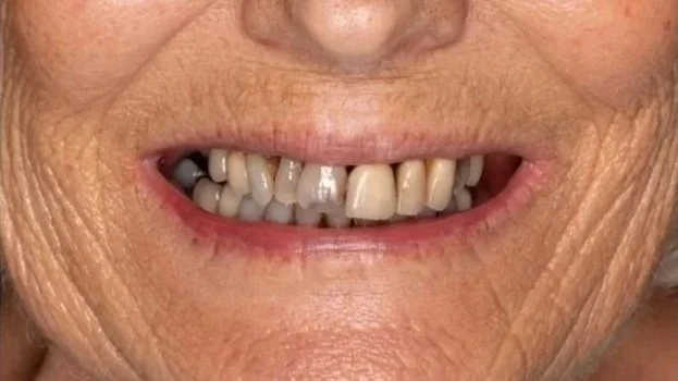 Close-up of an elderly person's mouth showing missing teeth, discolored and damaged teeth, and wrinkles around the lips.