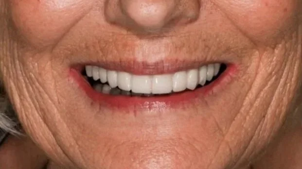 Close-up of a smiling elderly person's mouth showing white teeth and wrinkles around the lips.