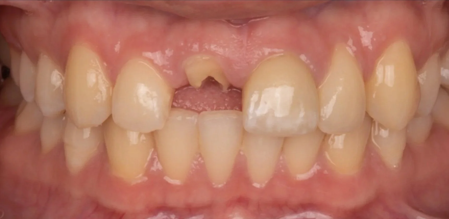 Open mouth showing decayed and missing front teeth.