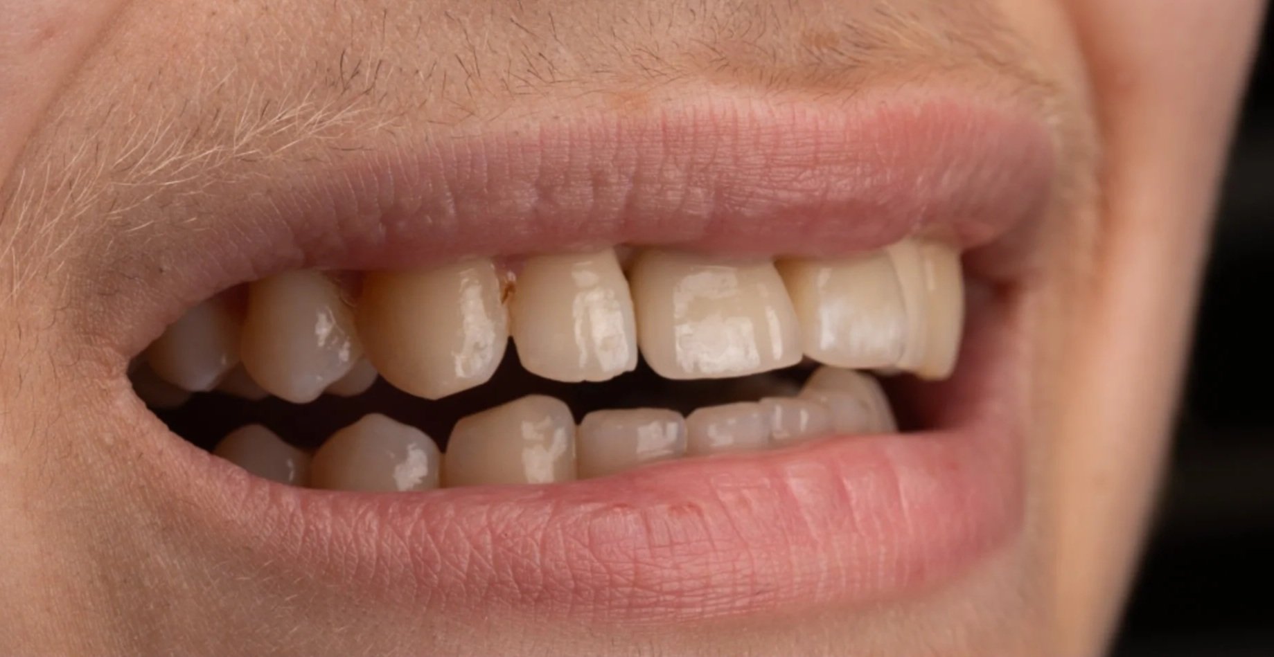 Close-up of a person's open mouth showing chipped and uneven upper teeth.