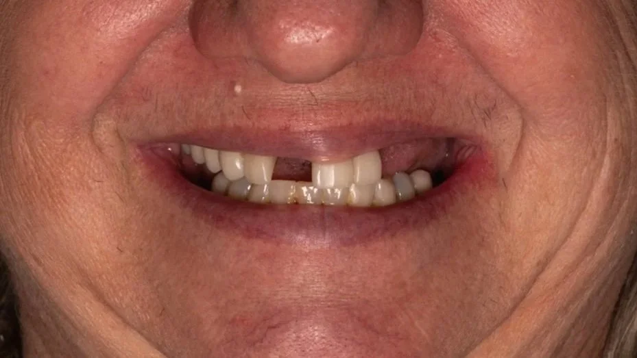Close-up of a person's mouth showing missing and broken teeth.