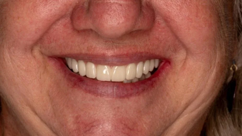 Close-up of a person's smile showing white upper teeth.
