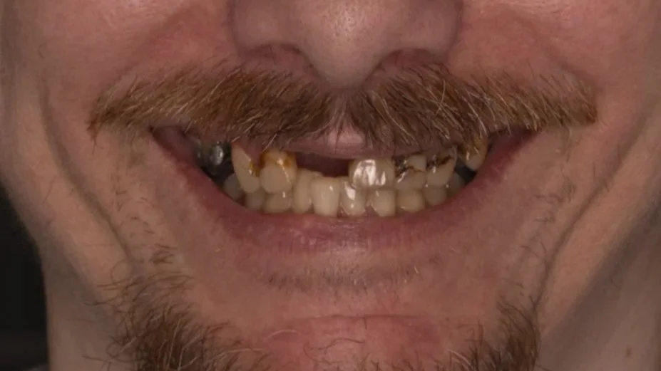 Close-up of a man's face showing teeth with significant decay, cavities, and discoloration.