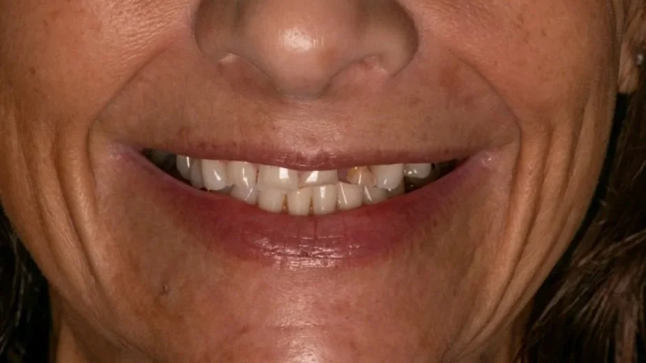 Close-up of a woman smiling, showing her teeth with some imperfections and discoloration.