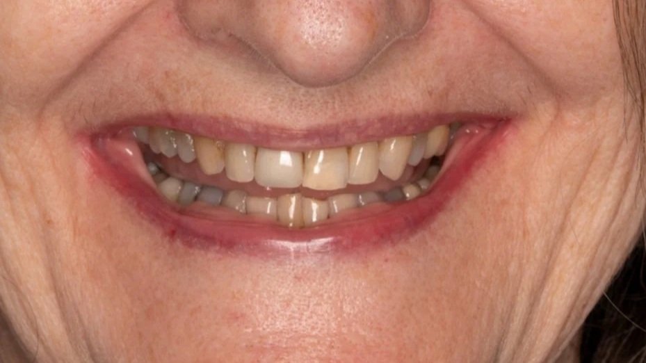 Close-up of a smile showing worn, discolored, and uneven teeth in an elderly person.