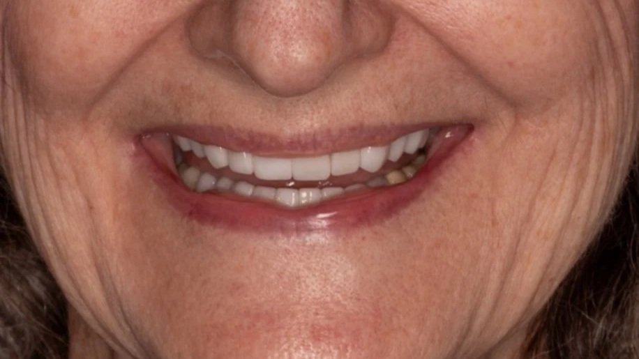 Close-up of a smiling elderly person's mouth with visible teeth and wrinkles around the mouth.