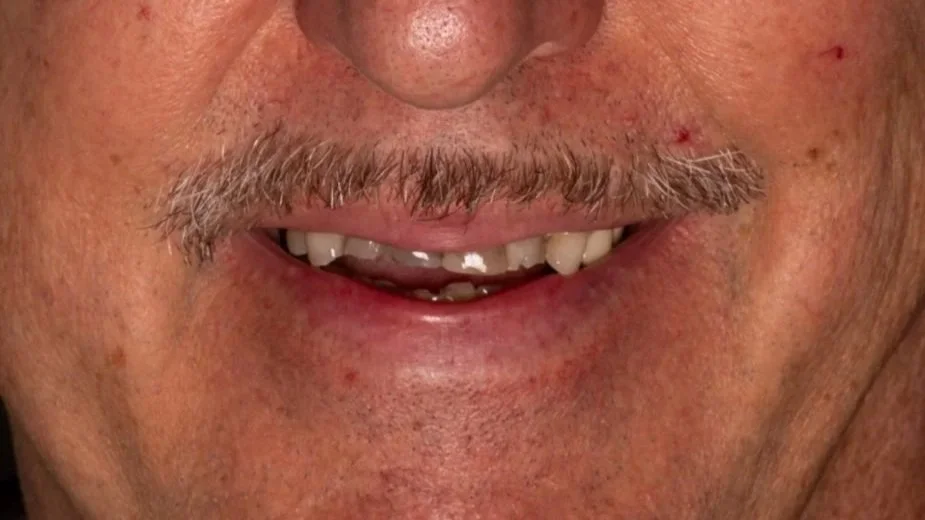 Close-up of a person's lower face showing a mustache, smirk, and missing teeth.