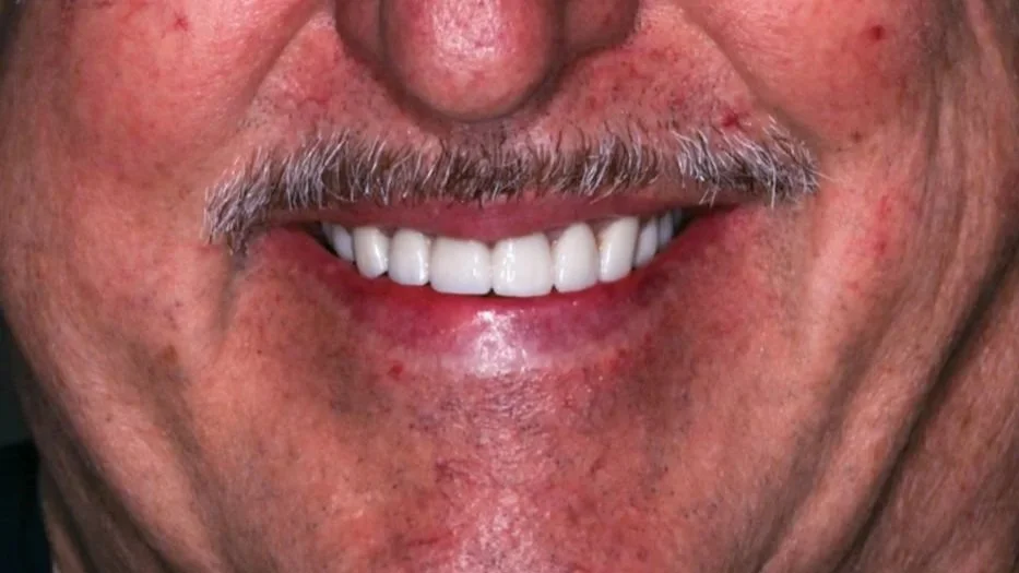 Close-up of a man's face showing a smile with bright white teeth, gray mustache, and skin with some redness and freckles.