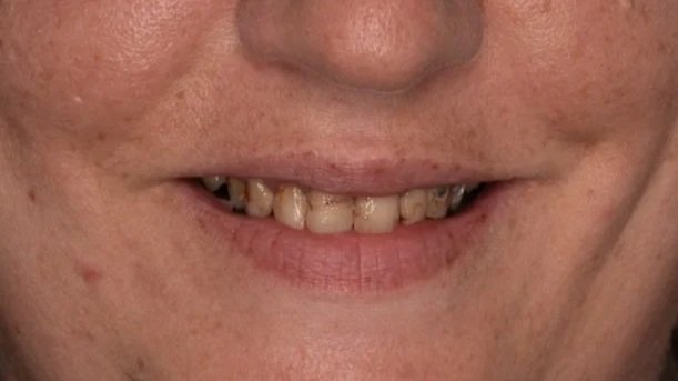 Close-up of a person's mouth showing stained and crooked teeth.