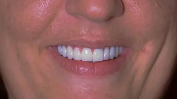 Close-up of a person's smile showing white teeth and lips.