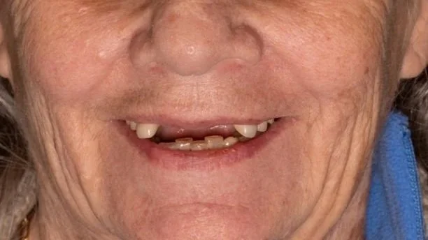 Close-up of an elderly person smiling, showing missing and misaligned teeth.