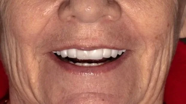 Close-up of an elderly person's smiling mouth showing white teeth.