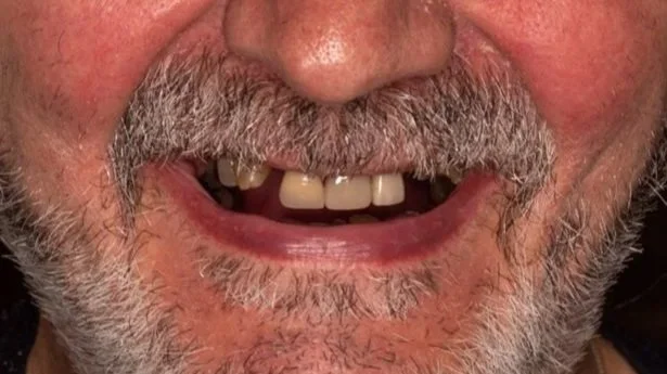 Close-up of a smiling man's face showing missing and uneven teeth.