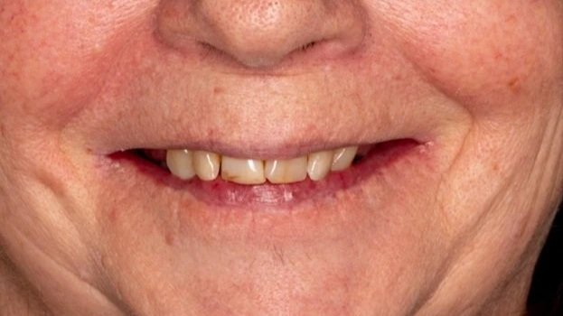 Close-up of a person's mouth showing slightly crooked teeth and a smile.