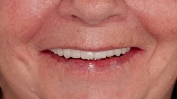 Close-up of a person's smiling mouth showing teeth with some dental work.