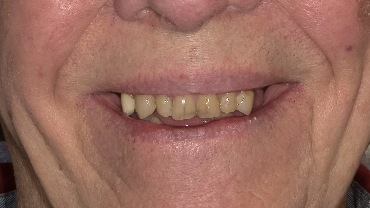 Close-up of an elderly person's mouth showing uneven, discolored teeth with some gaps.