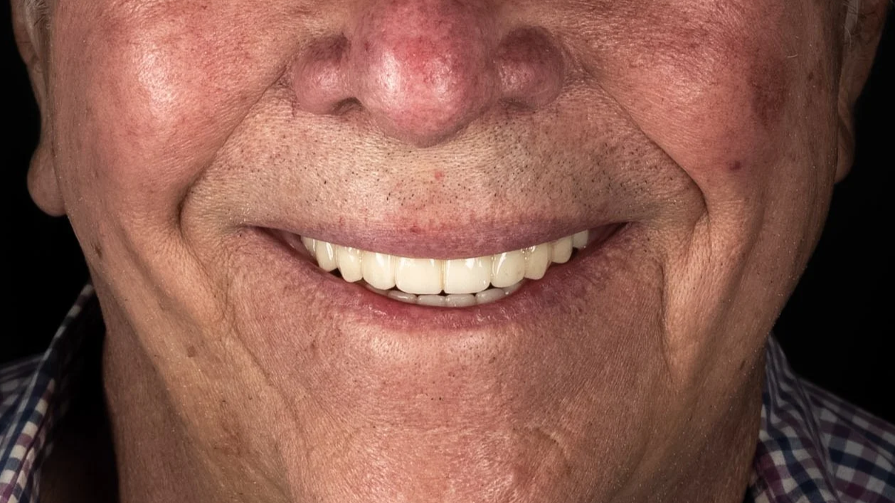 Close-up of a smiling man showing his teeth with a natural skin tone.