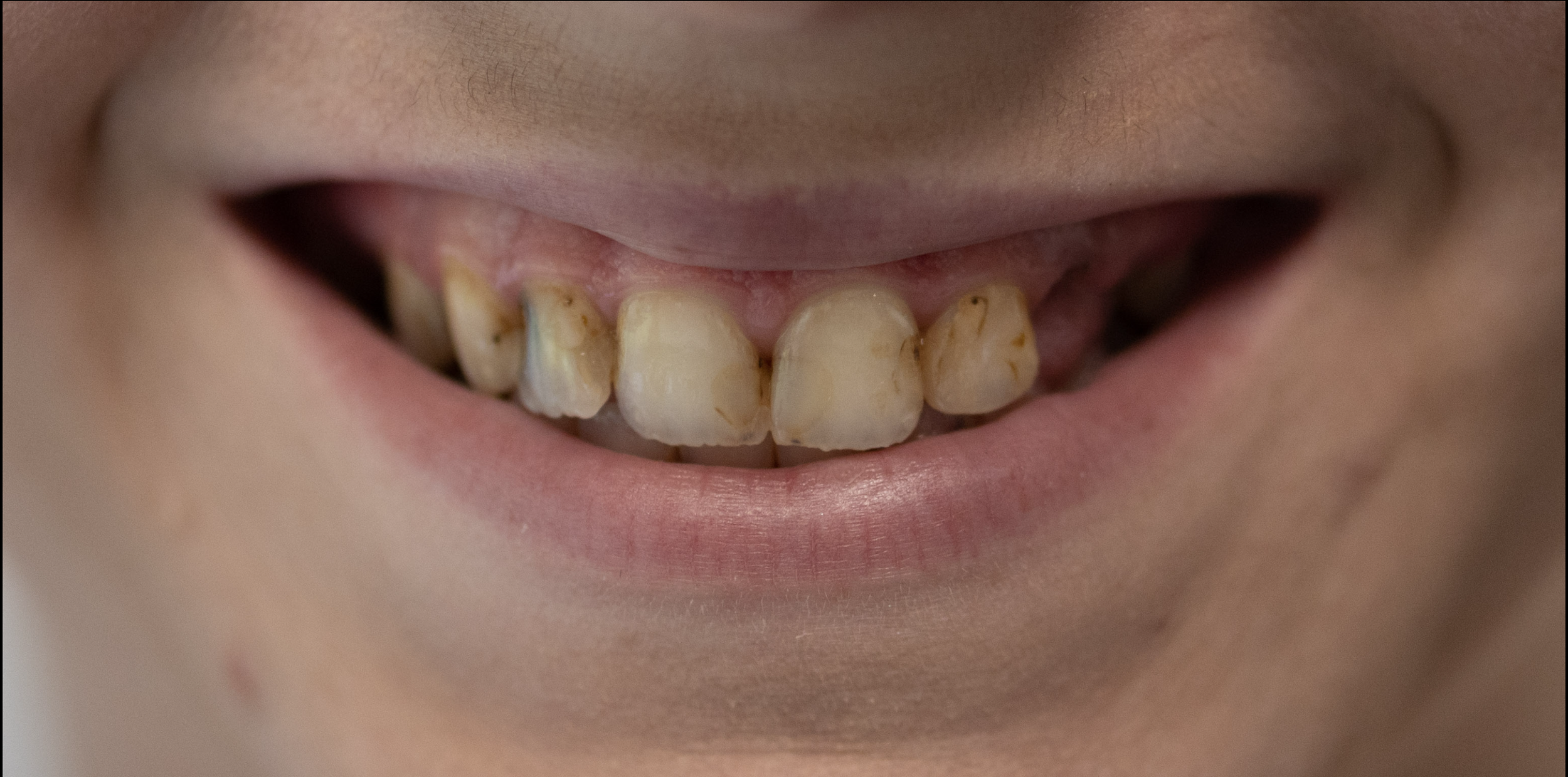 Close-up of a child's mouth showing discolored and decayed upper front teeth.