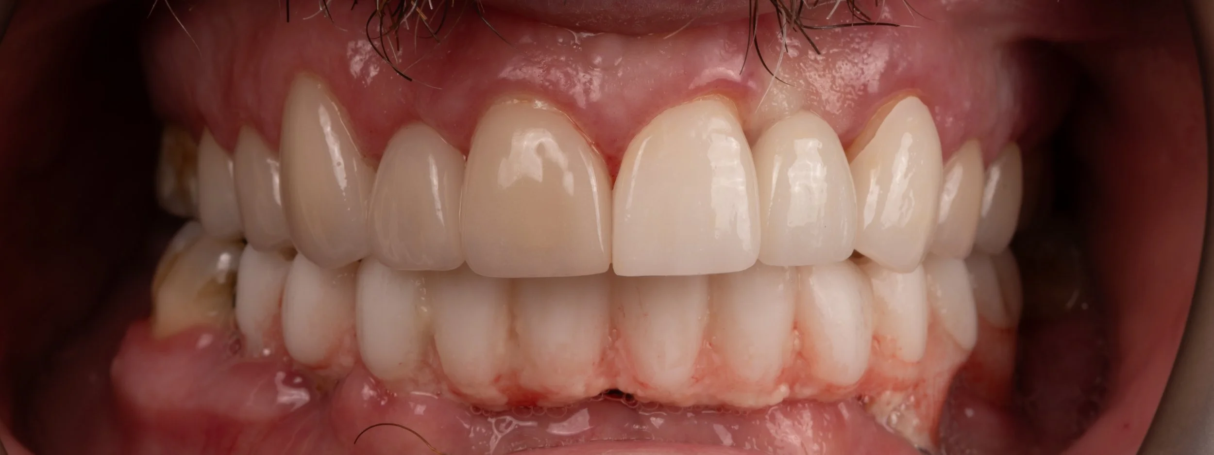 Close-up of a person's mouth showing teeth, gums, and part of the upper jaw with visible teeth and pink gums.