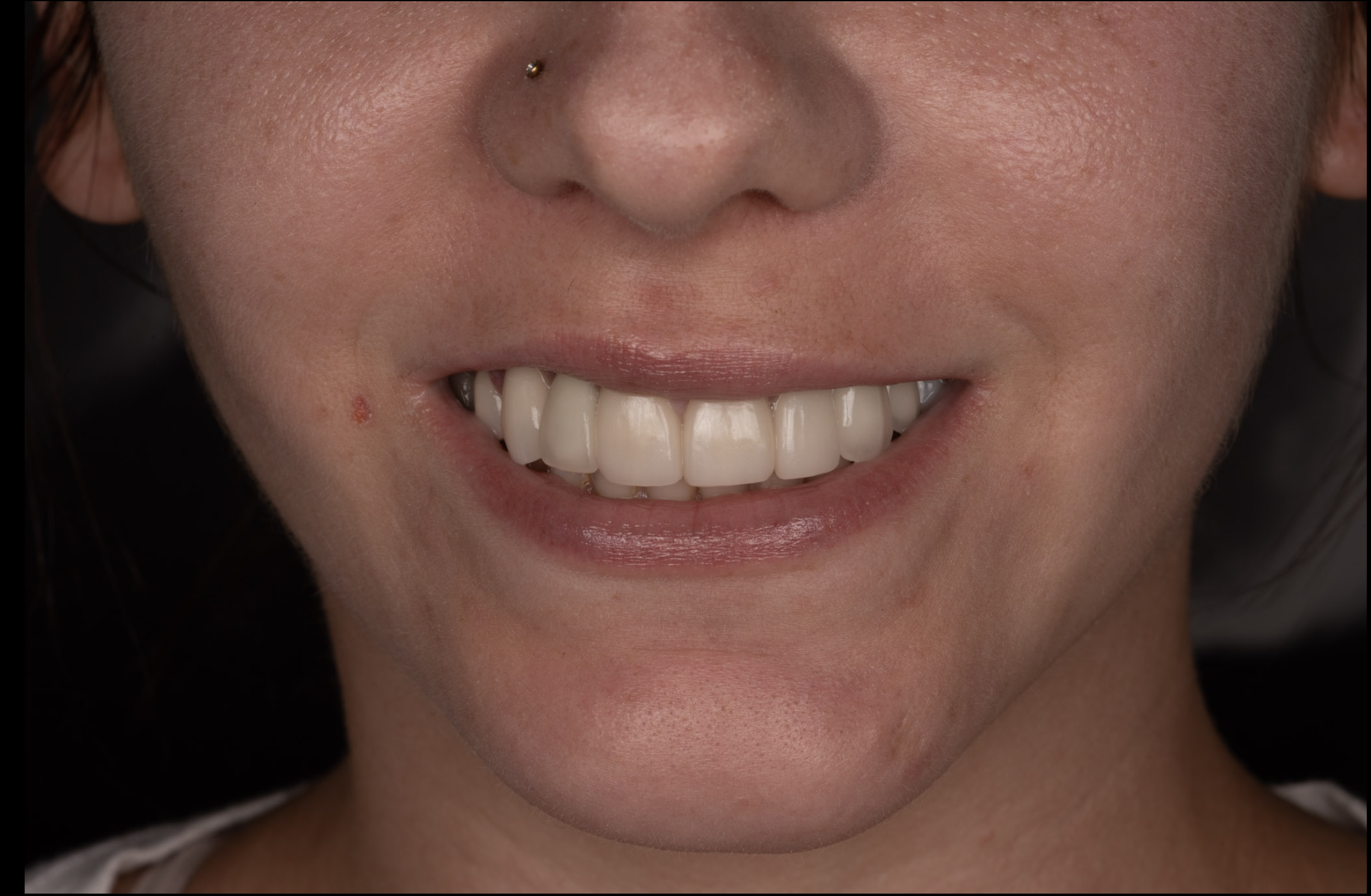 Close-up of a person's smiling mouth showing white teeth with a small pimple on the lower left cheek.