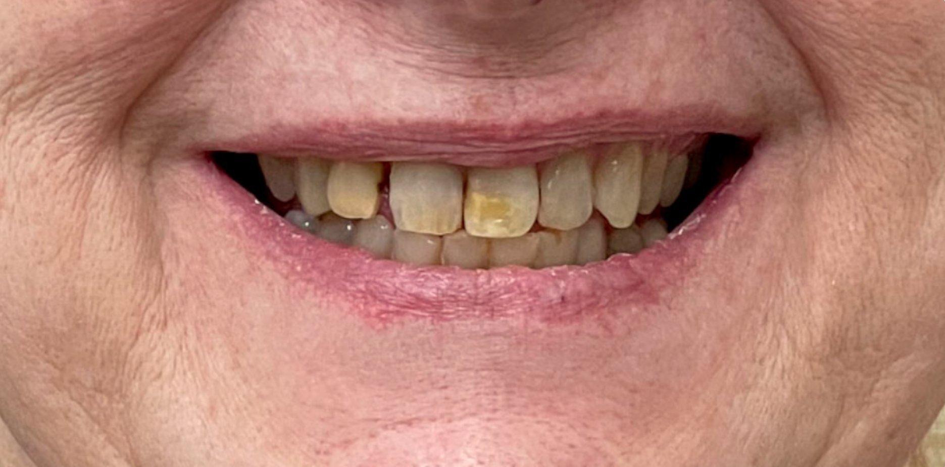 Close-up of a person smiling showing discolored and decayed teeth.