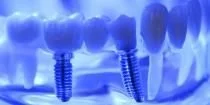 Discover the Difference Between Dental Implants &amp; Dentures at Hulse Dental