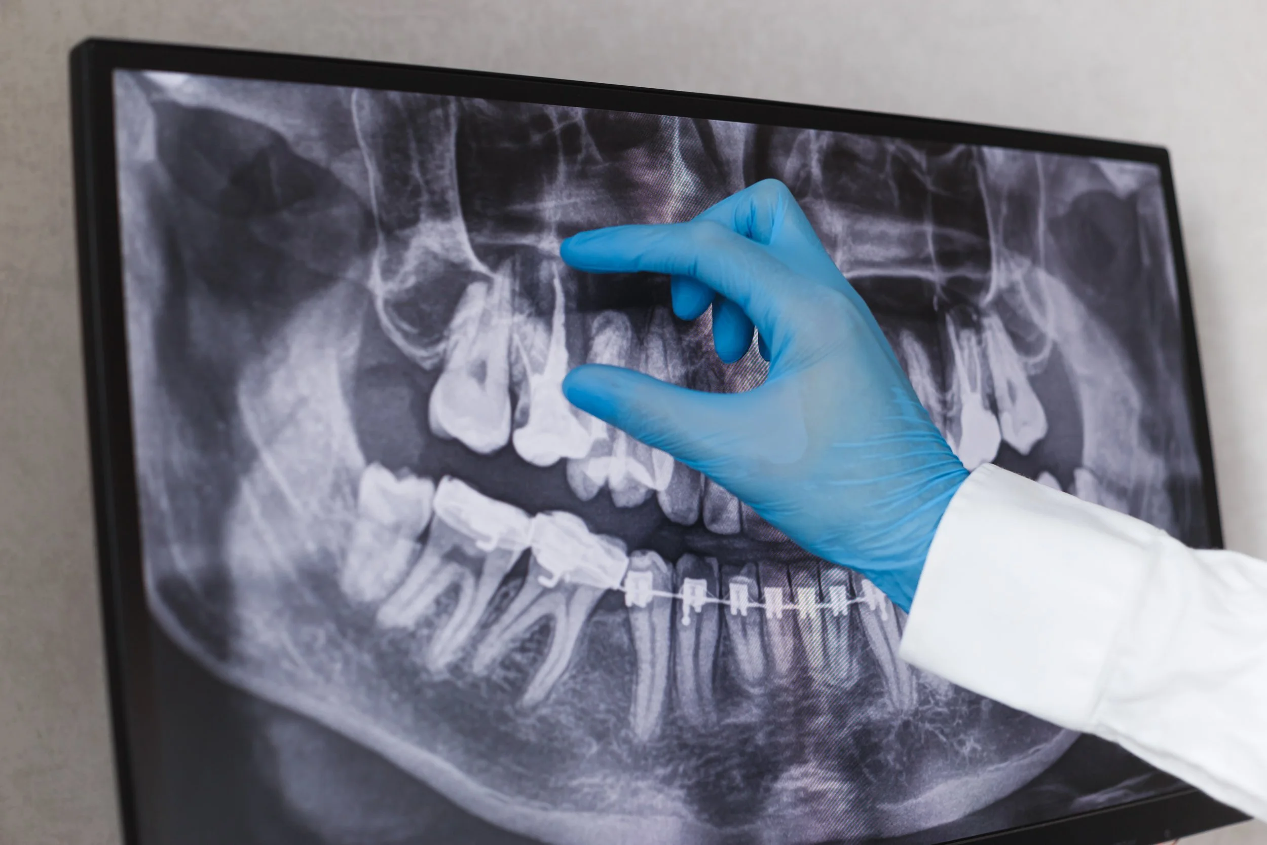 Close-up of a medical professional wearing blue gloves pointing at a dental X-ray displayed on a screen.