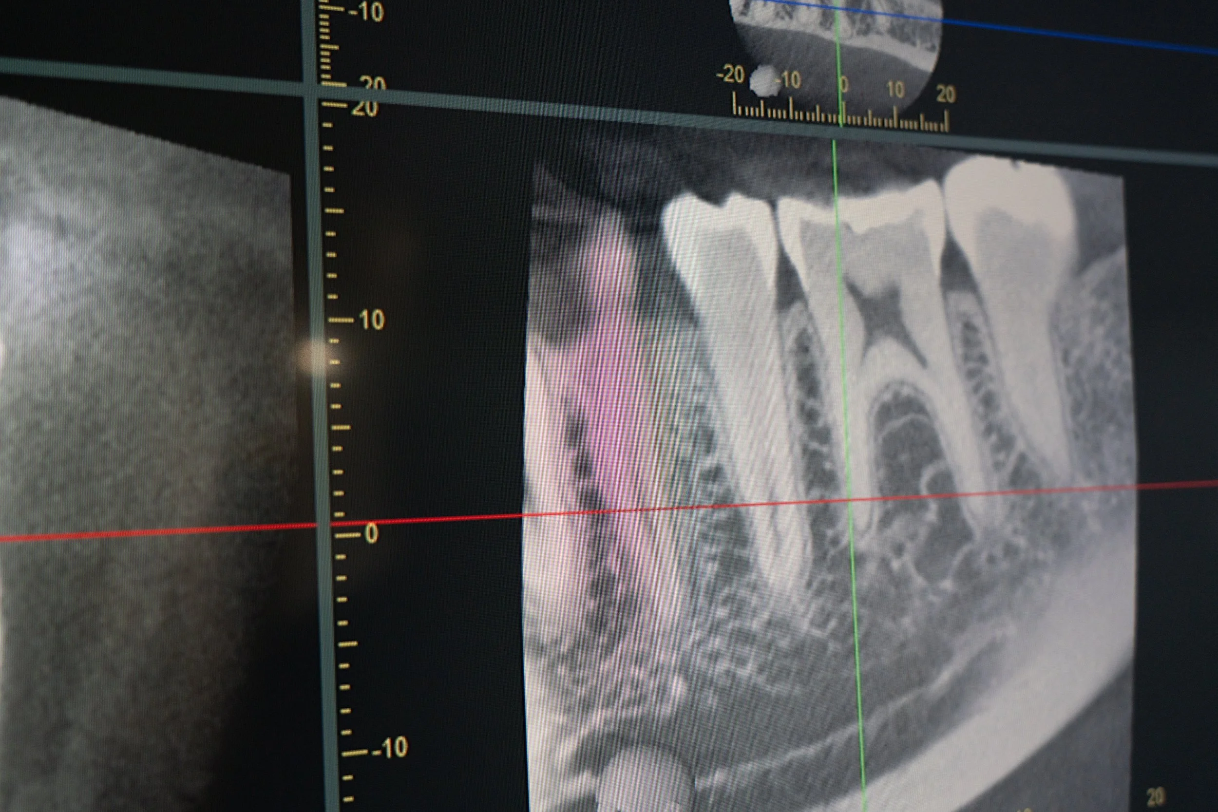 Dental X-ray showing teeth and jawbone with measurement markers and grid lines.