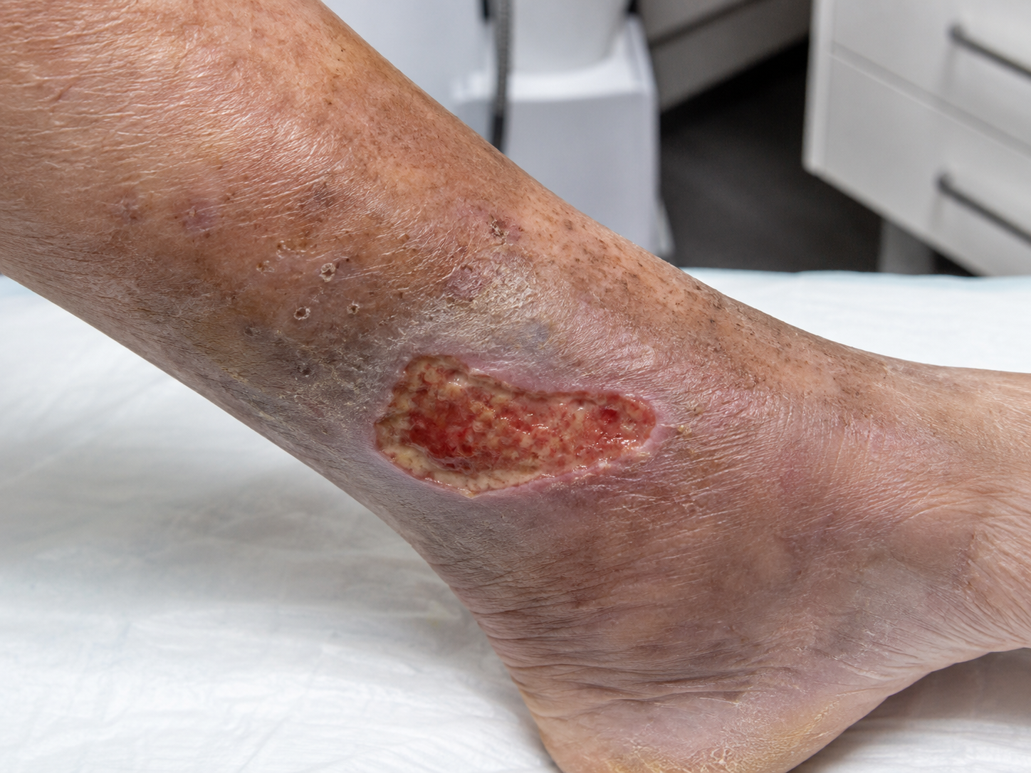 Venous Leg Ulcers