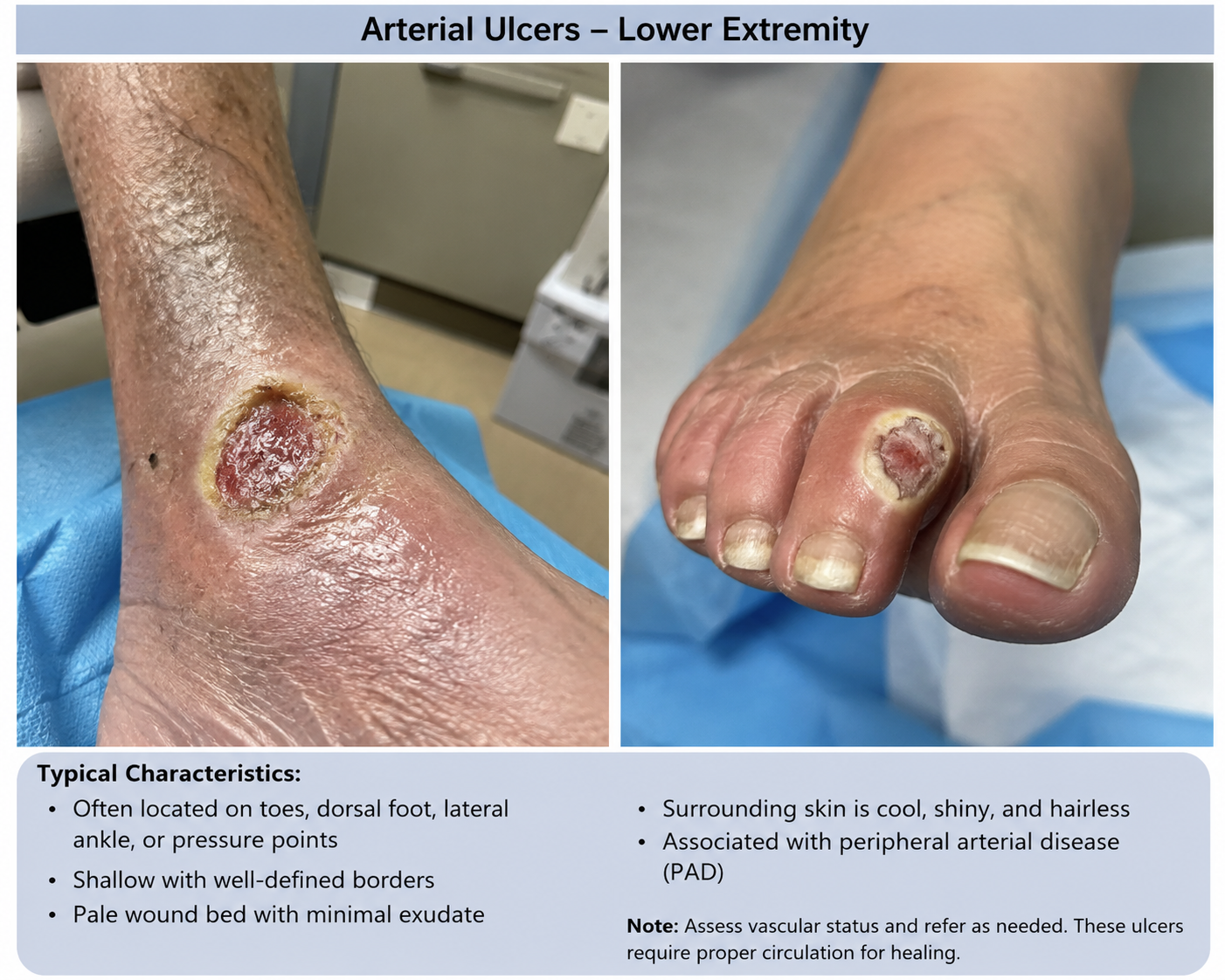 Arterial Ulcers
