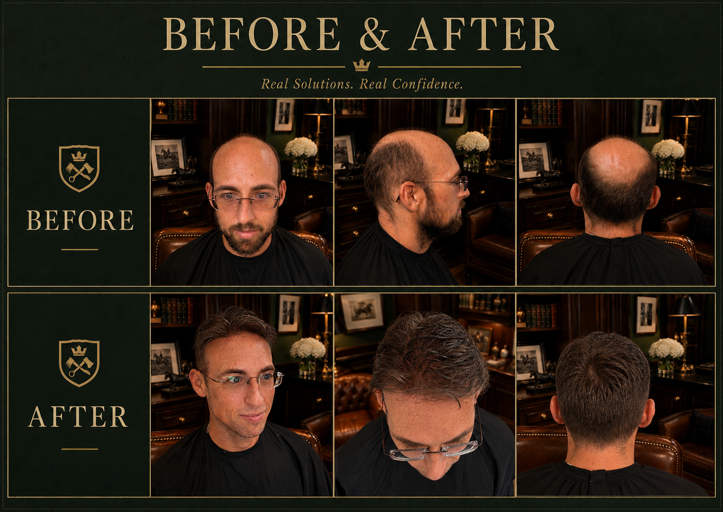 Before and after photos showcasing a man's hair transformation, with the 'before' images displaying a receding hairline and bald spots, and the 'after' images showing a fuller head of hair.
