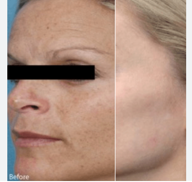 Microneedling with PRP