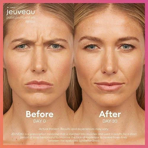 Jeuveau® Neurotoxin