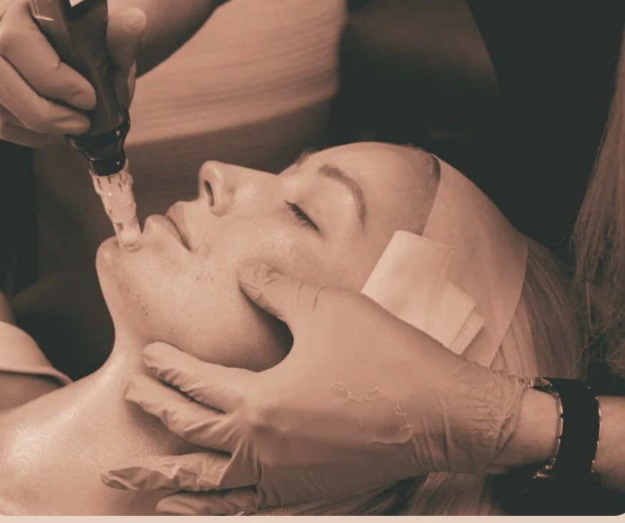 A client receiving a SkinPen microneedling treatment on her face at Covent Garden Skin Clinic.