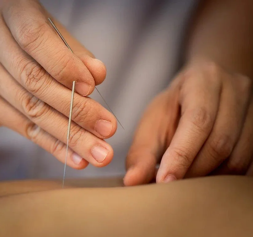 A close-up of a person's hand inserting acupuncture needles into skin.
