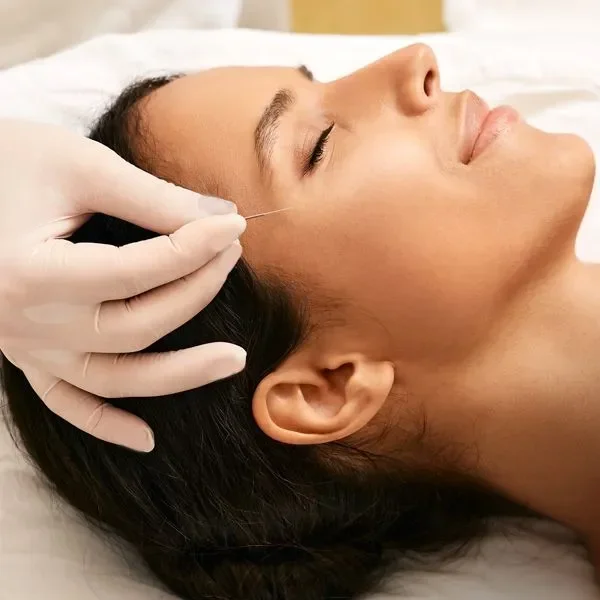 Face acupuncture
