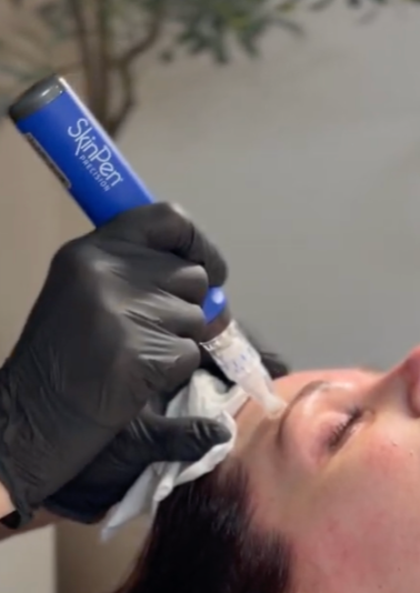 SkinPen® The Treatment Everyone Is Talking About (And Why We Love It)