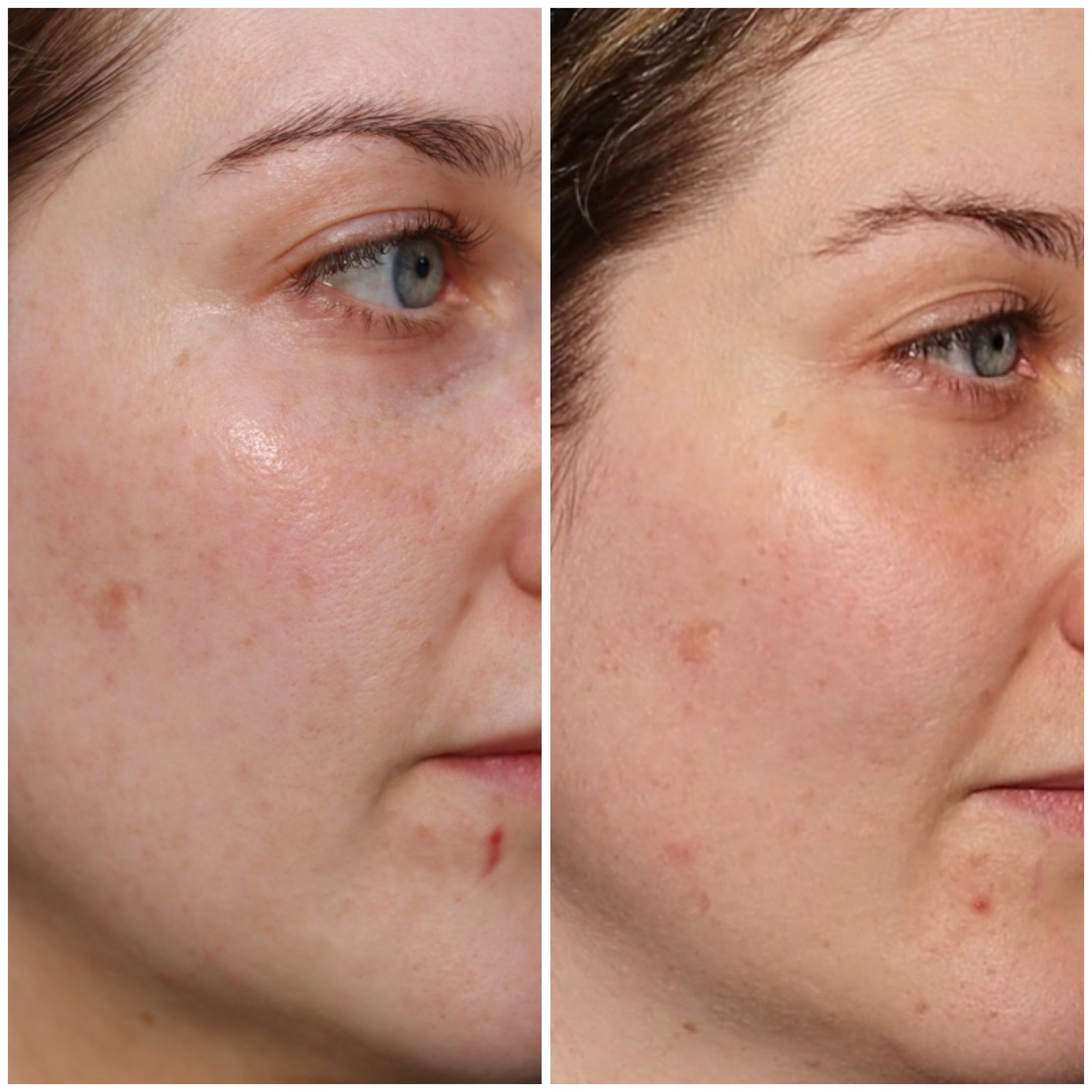 Close-up comparison of a person's face before and after shaven or microblading, showing changes in eyebrow appearance and facial skin.