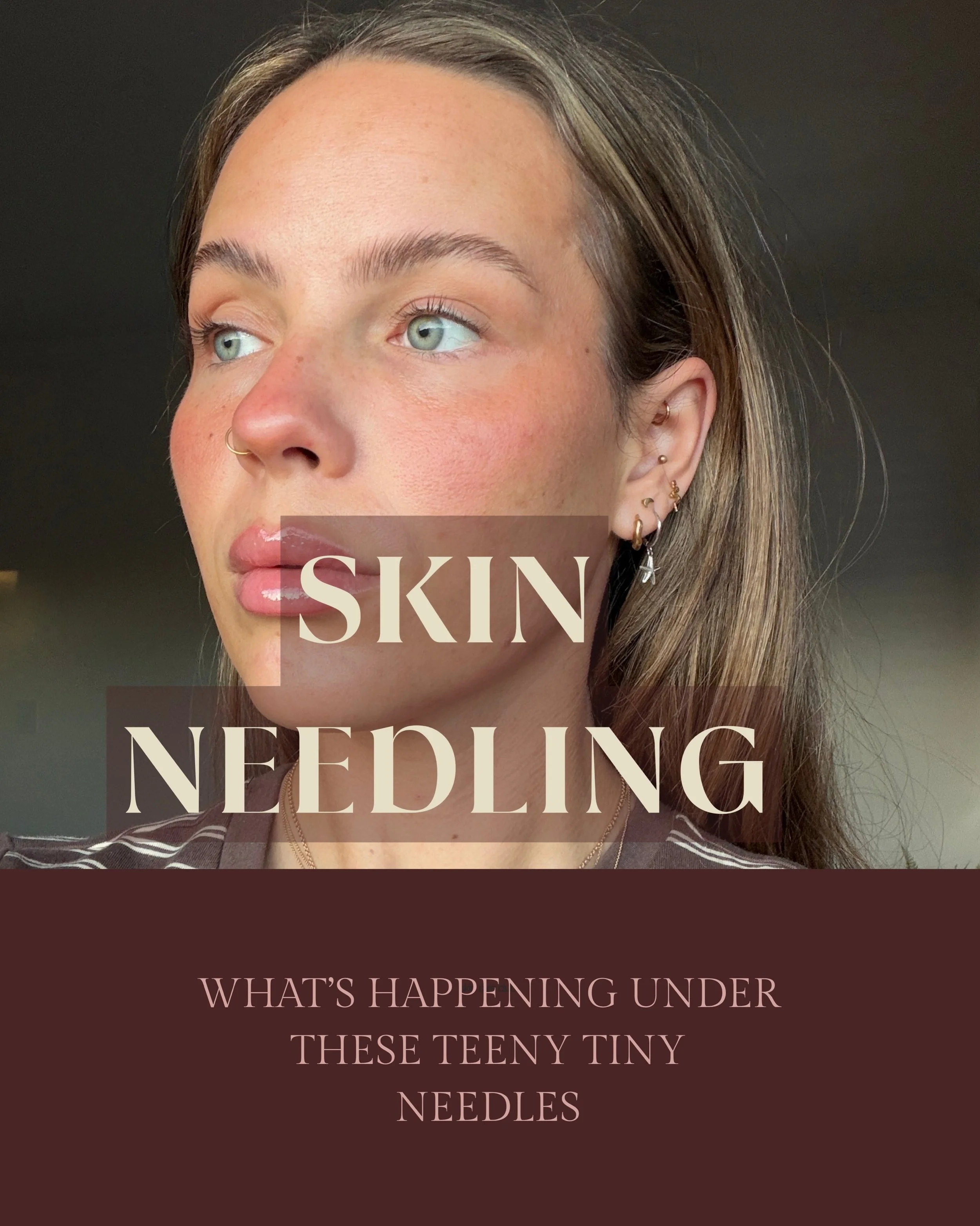 Let&rsquo;s talk skin needling AKA micro-needling!

It&rsquo;s not just &ldquo;tiny needles poking your face&rdquo; &mdash; it&rsquo;s your skin&rsquo;s wake-up call.

Those micro-channels tell your body &ldquo;time to repair,&rdquo; which kicks coll