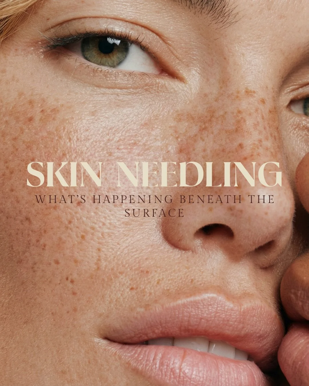 Skin Needling is getting an upgrade at Kept 🫶🏼🤭 So no better time to start a little series about one of my fav treatments!

Tiny, controlled micro-channels are created in the skin. Your skin reads that as something to repair and gets to work, incr