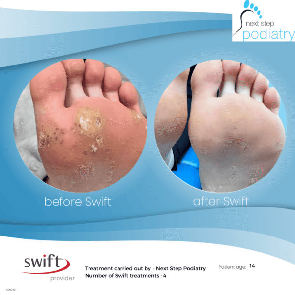 Comparison of a patient's foot before and after four Swift treatments, showing clearing of plantar warts.