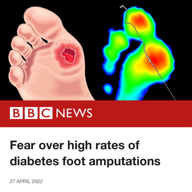 Illustration of a diabetic foot ulcer and a heat map indicating foot pain or temperature, with the BBC News logo and a headline about fear of high rates of diabetes-related foot amputations.