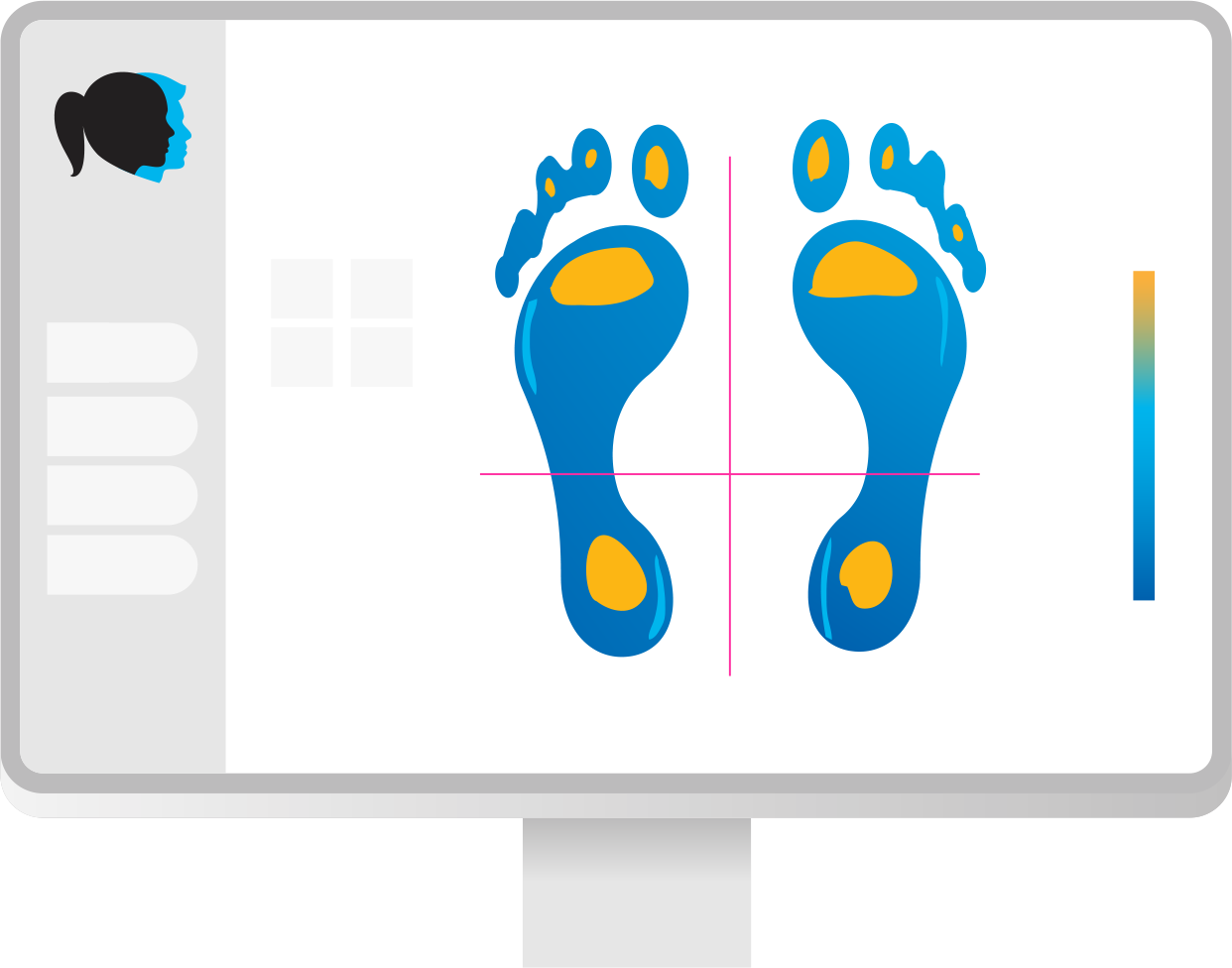 Foot pressure analysis displayed on a computer screen, showing different pressure points in yellow on both feet with a color bar indicating pressure levels.