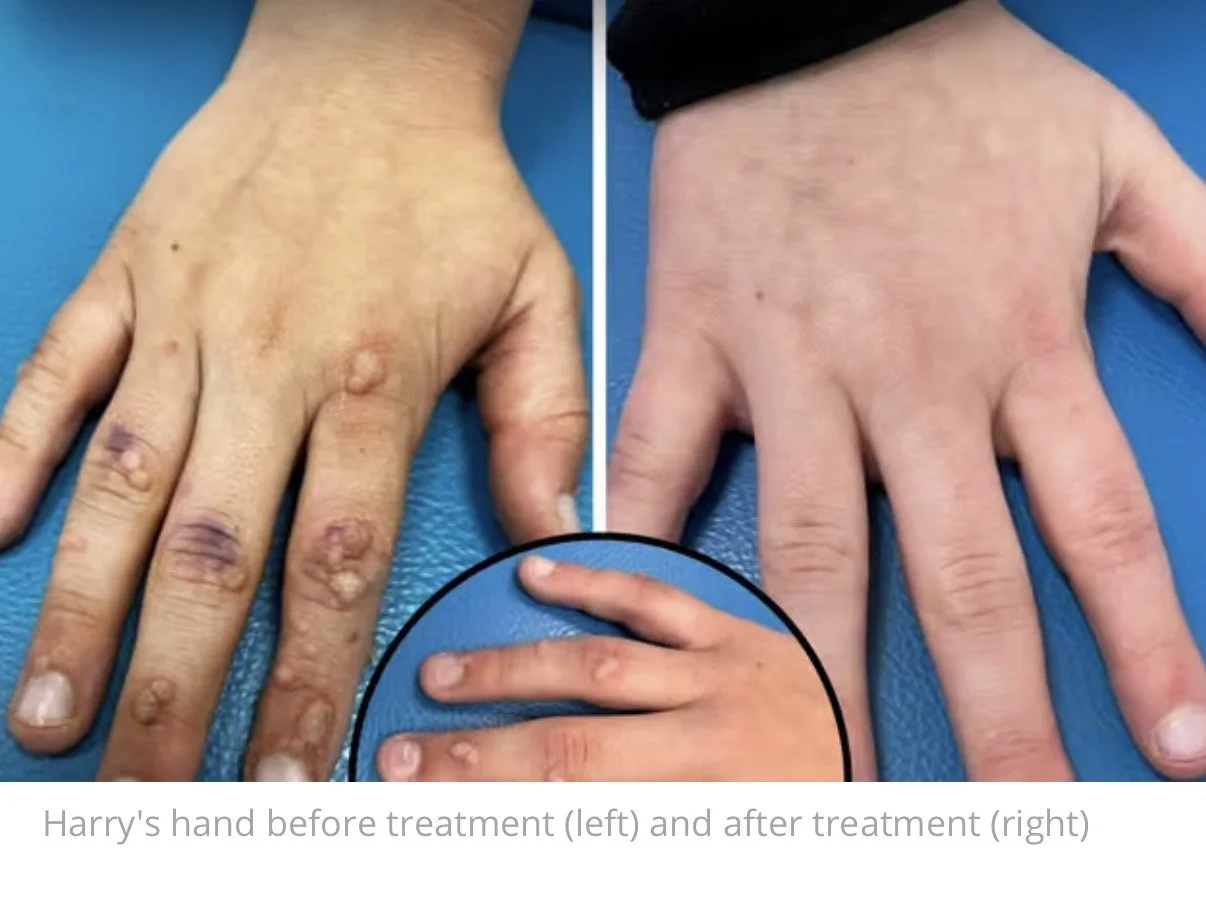 Comparison of Harry's hand before and after treatment showing healing of skin lesions on the left and clear skin on the right.
