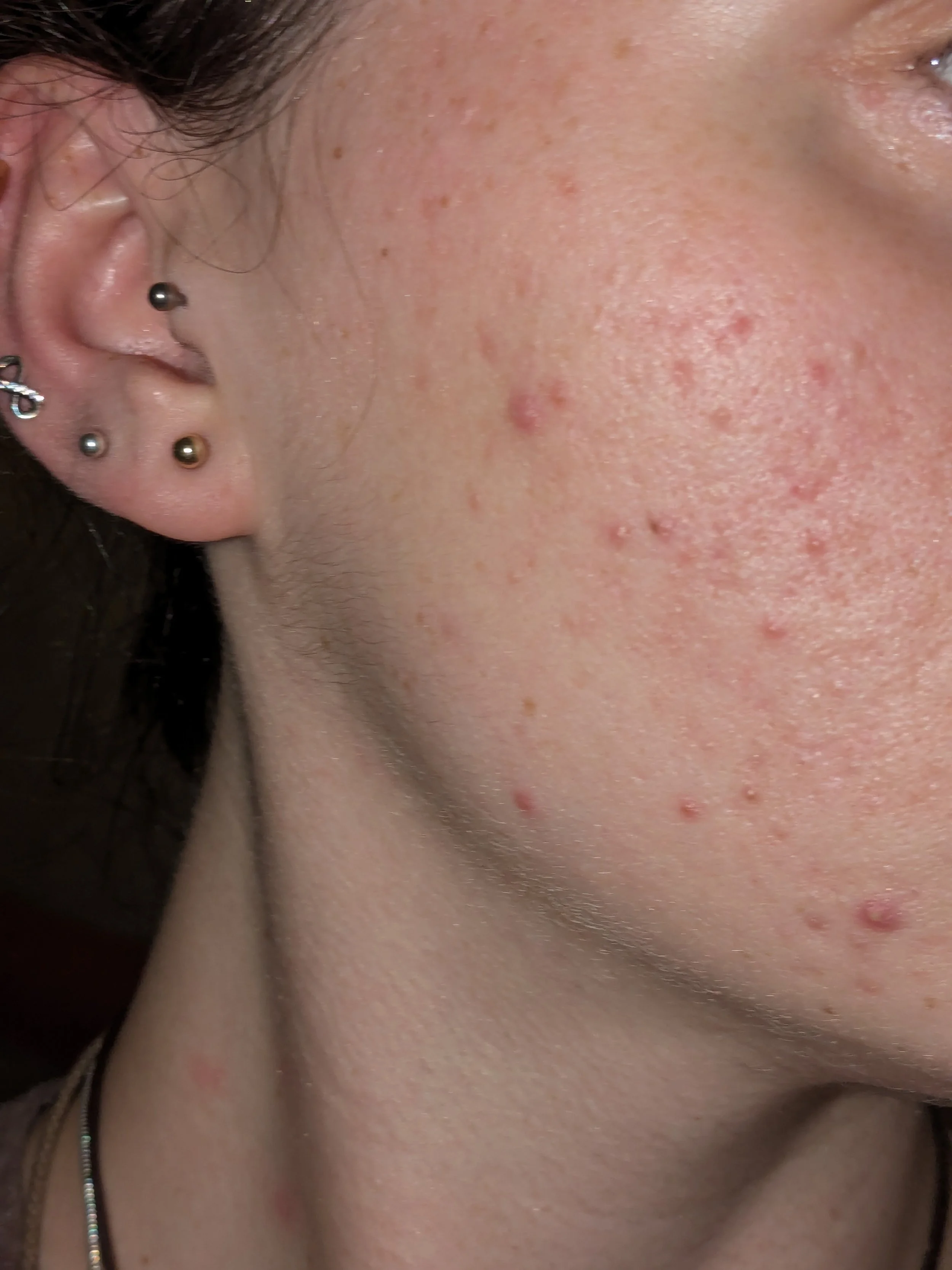 Close-up of a person's cheek showing acne and skin redness.