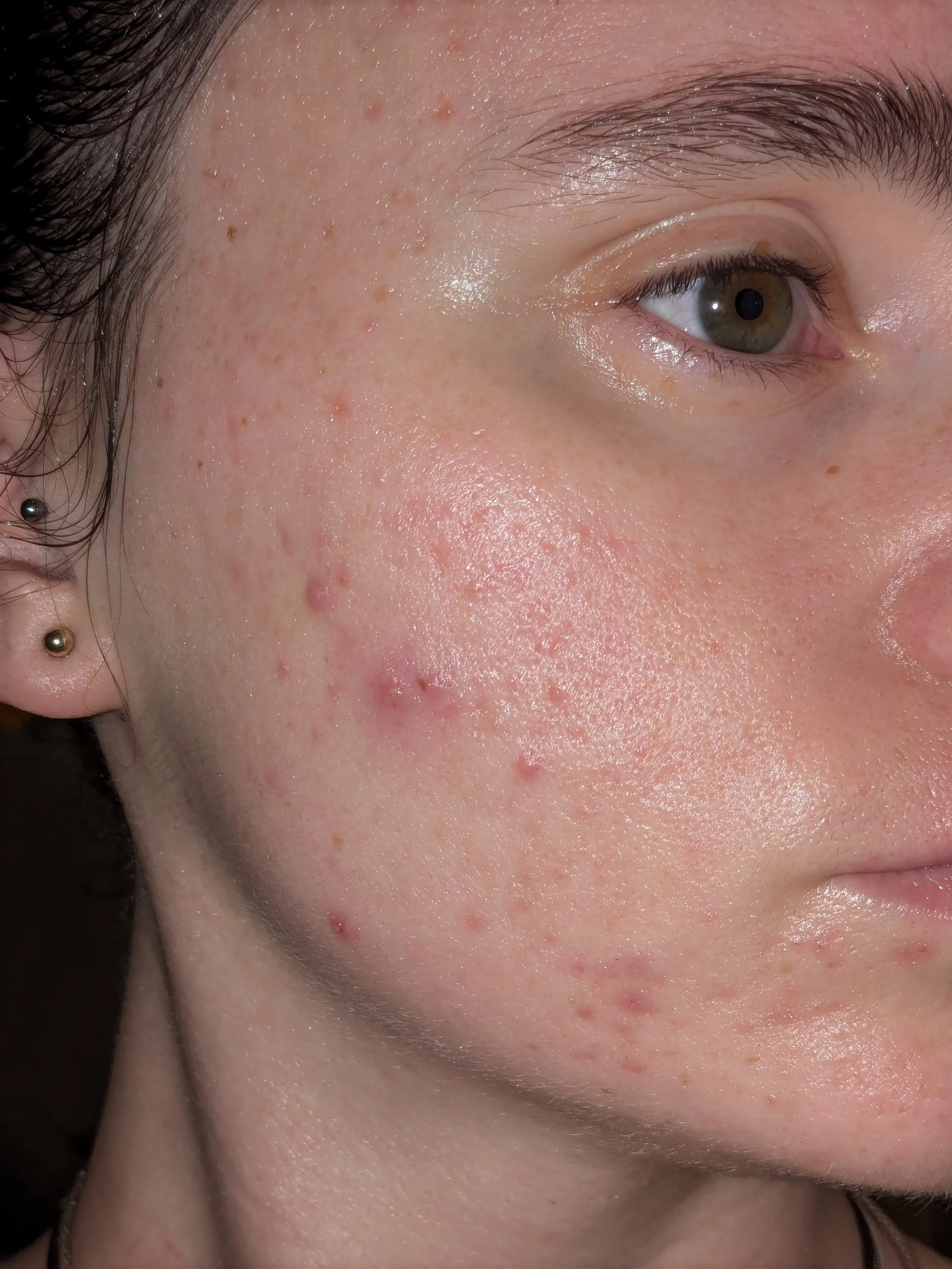 Close-up of a person's face showing the right eye, eyebrow, and cheek, with acne and skin imperfections.