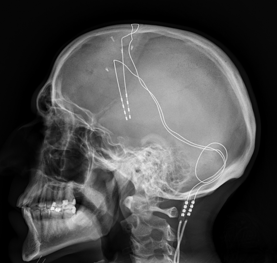 Brain Pacemakers in Consumer Medical Electronics Improve Quality of Life-Part II