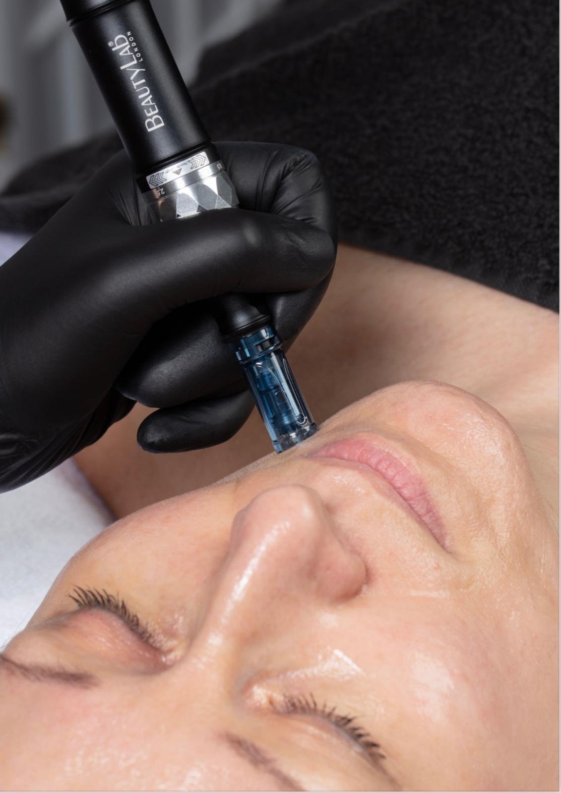Microneedling treatment being performed