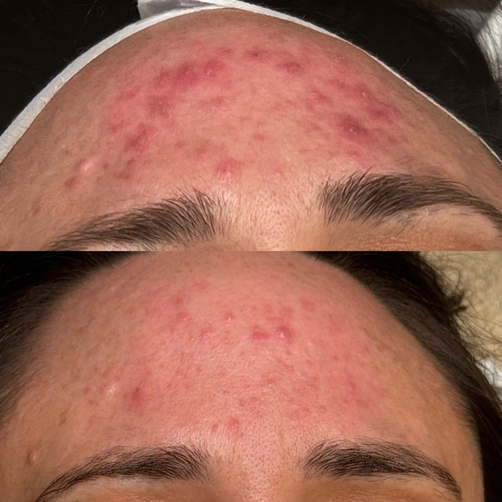 Before & after Microneedling & Dermalux shows skin improvement