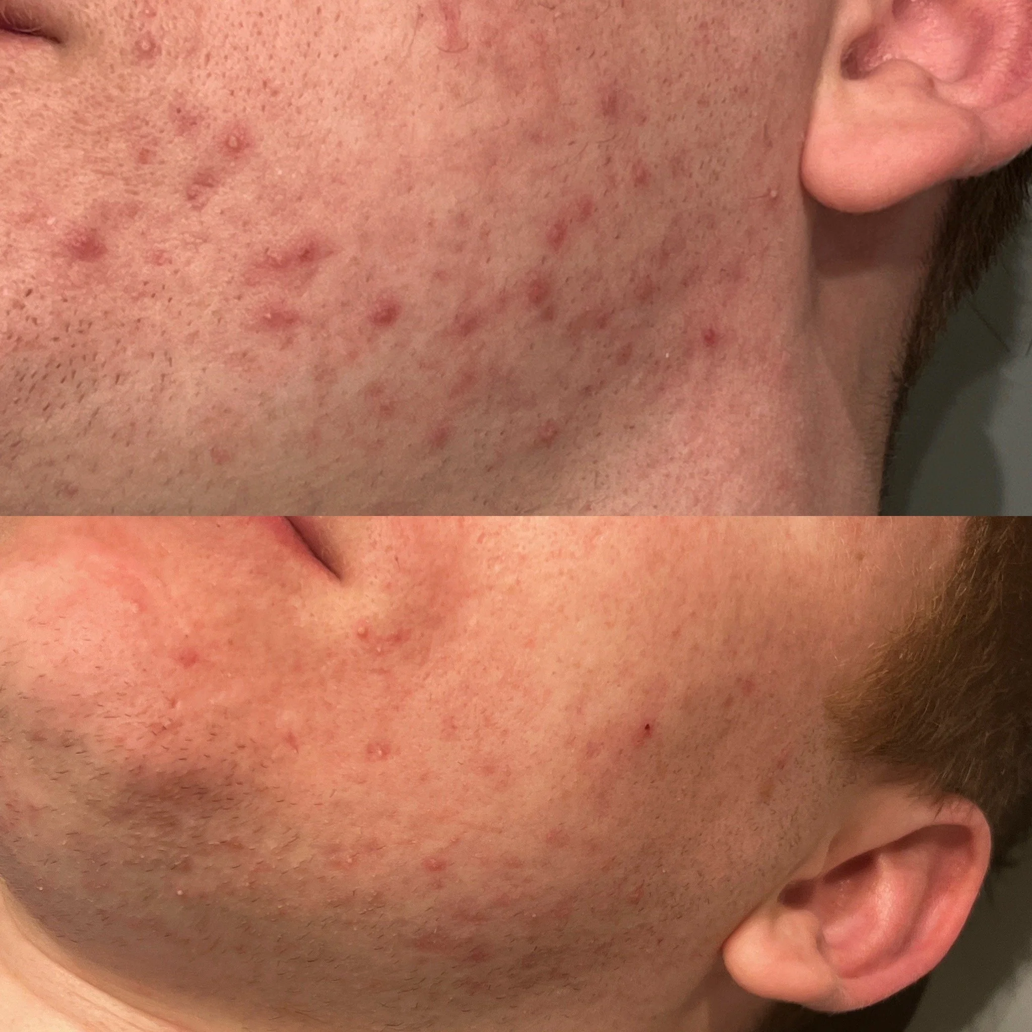 Before and after Dermalux Light Therapy Treatment